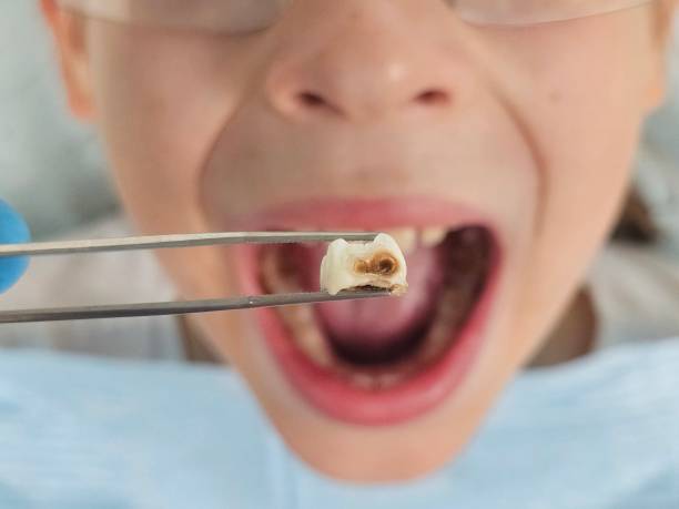 Best Broken or Chipped Tooth Repair in Gifford, FL